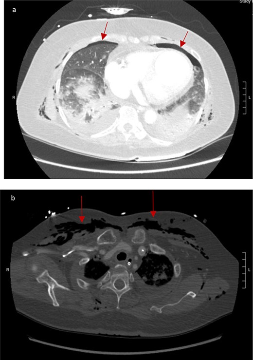 (a) Bilateral anterior pneumothoraces; (b) moderate volume of subcutaneous emphysema in the anterior chest wall.