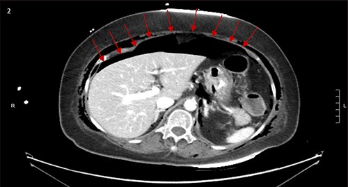 Large pneumoperitoneum with subcutaneous emphysema.