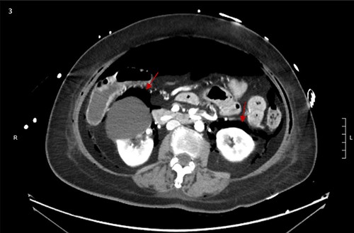 Bilateral retroperitoneal air surrounding right and left kidneys.