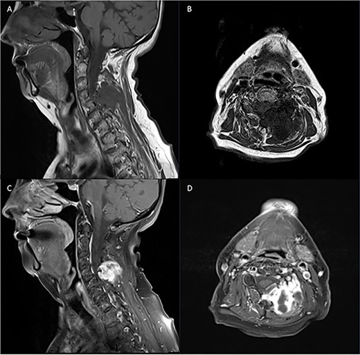 Pre-operative T1 and T2 weighted MRI: left-sided extra-axial mass at C4/5 hypointense on T1 and hyperintense on T2.