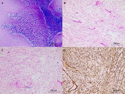 Histological staining of intraoperative tumour smears: (A) intraoperative smear Toluidine blue stained slide. (B): H&E ×10. (C): H&E ×10. (D): vimentin IHC ×10.
