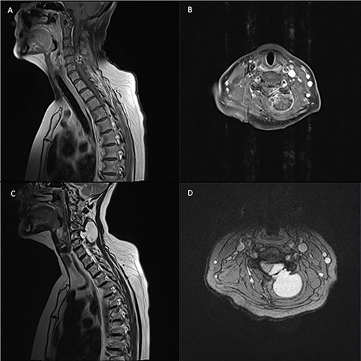 Pre-operative T1 post Gadolinium and T2 weighted MRI: left-sided extra-axial mass at C5/6 with heterogenous enhancement on T1 and hyperintense on T2. Moderate compression of the spinal cord and invasion into surrounding soft tissue.