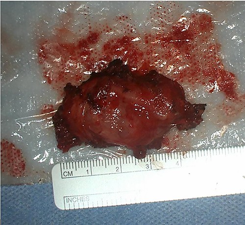 Tumour specimen resected en bloc. Solitary, relatively well-delineated nodule covered by a thick capsule measuring 30 × 25 × 20 mm.