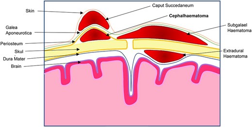 Drawing of scalp demonstrating tssshe locations of common haematomas of the scalp in relation to the different layers.