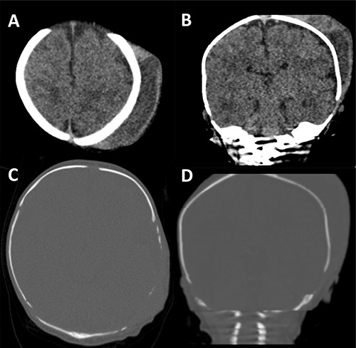 CT scan of our patient. In (A) and (B) the size of the cephalhaematoma can clearly be seen. In (C) and (D) the thinned, moth-eaten appearance of the left parietal region is well demonstrated.
