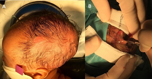 Photos illustrating the clinical stigmata of infection. In (A) the region of the infected cephalhaematoma is defined by erythema and an overlying abrasion. In (B) incision is made and the purulent collection seen.