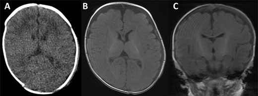 CT scan and MRI taken of the patient upon discharge. In all images, a well-defined skull with no thinning is illustrated and with a resolved haematoma.
