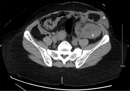 A computed tomography scan of the abdomen with no intravenous contrast obtained 3 years prior to the sentinel event. The kidney allograft (K) appears in the left iliac fossa just beneath a wide-neck abdominal wall incisional hernia with protruding small bowel loops (B).