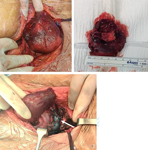 Intraoperative photos. (A) The allograft cut surface after removal of the upper pole. The geographic discoloration reflects presence of areas of poor perfusion is evident. (B) The excised upper pole due to iatrogenic injury. (C) Intraoperative photo of the allograft kidney when medialized. The ligated upper calyx appears stained blue (white arrow) due to testing with the methylene blue to assess for areas of potential leak.
