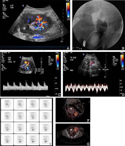 (A) Intraoperative US doppler at the cut surface of the allograft revealing partial perfusion of the allograft as some areas lacked vascular signal reflecting poor perfusion (labelled with asterixis). (B) Intraoperative retrograde ureterogram to test for urine