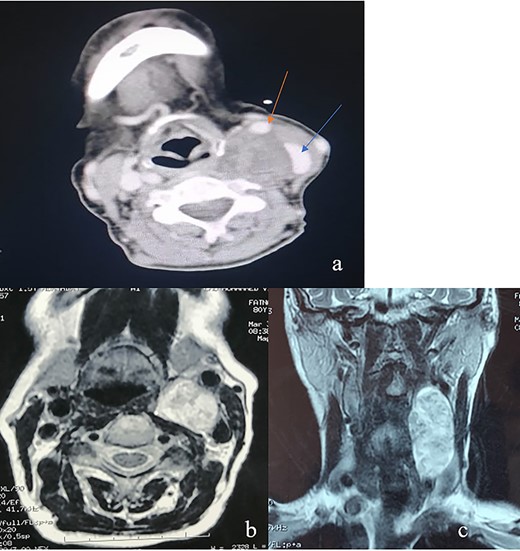 (a) An axial CT of the neck revealing an oval heterogeneous mass in the left carotid space measuring 37 × 30 × 57 mm; the IJV (blue arrow) is displaced laterally and the CCA (red arrow) is displaced anteriorly; this is often a characteristic sign of VNS; (b) an axial T2-weighted MRI; left carotid space mass, noninfiltrating widening the space between CCE and IJV; (c) an coronal T2-weighted MRI showing a left carotid space mass with vertical major axis.