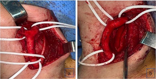 (a) Schwannoma causing anterior displacement of CCA, ICA and ECA; the vagus nerve running over the top of the mass; (b) complete resection of the schwannoma with preservation of the vagus nerve.