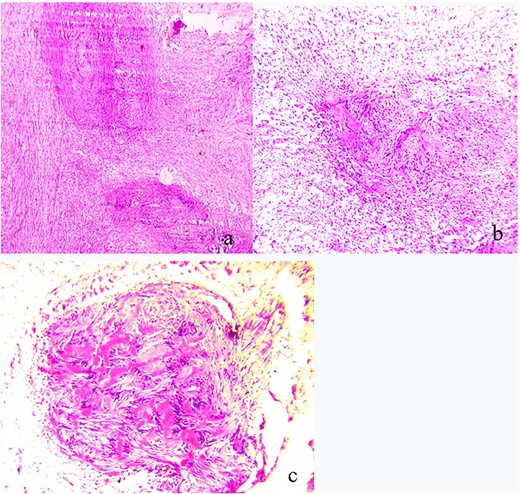 (a) Pathologic findings demonstrating plexiform schwannoma; (b) both Antoni A and Antoni B areas; (c) Verocay bodies.