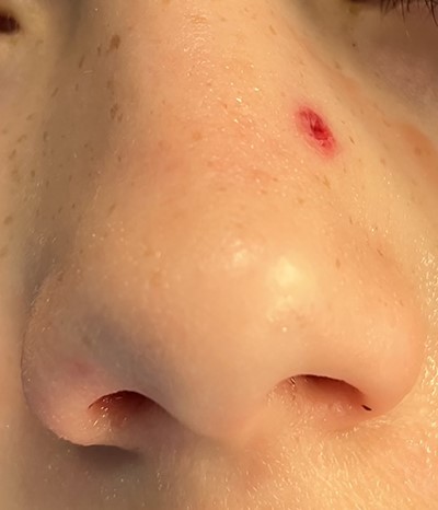 Entry wound of left nasal sidewall.