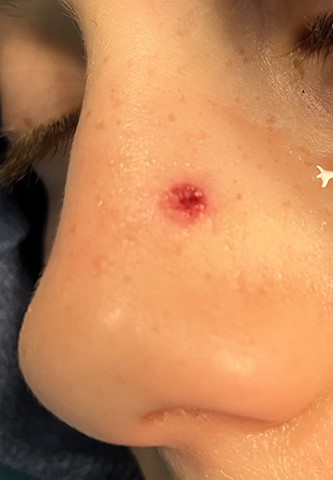Entry wound of left nasal sidewall.