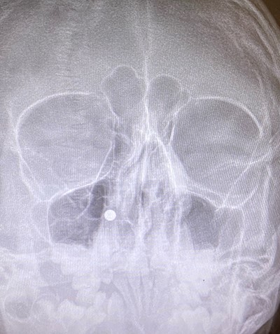 Coronal view X-ray of sinuses.