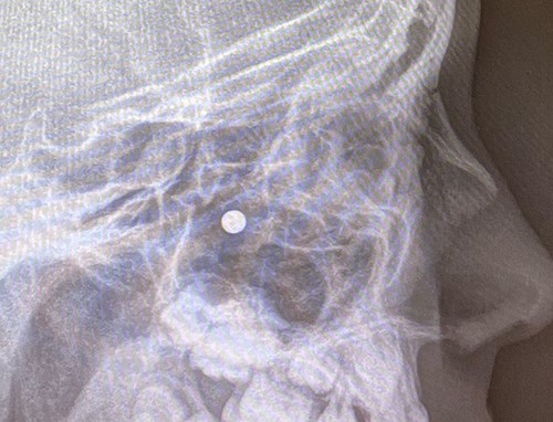 Sagittal view X-ray of sinuses.