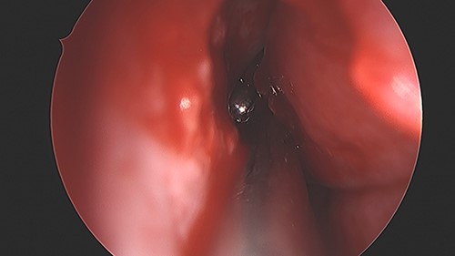 BB bullet located in the right nasal cavity.