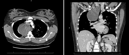 CT axial and coronal views demonstrating the right middle mediastinal mass (8 cm × 10 cm × 7.4 cm) with distal tracheal extrinsic compression.