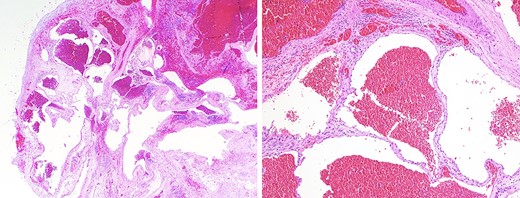 (a) low-power microscopic view (hematoxylin and eosin stain; 20X magnification) showing a well-circumscribed tumor composed of ectatic blood-filled spaces separated by intervening fibrous stroma with scattered lymphoid aggregates, entrapped fat and smooth muscle proliferation; (b) medium-power microscopic view (hematoxylin and eosin stain; 100X magnification) highlighting the presence of endothelial cells lining blood-filled spaces, confirming the diagnosis of a benign hemangioma.