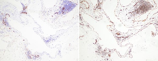 (a) immunohistochemical staining with antibodies for ERG, an endothelial marker, shows strong and diffuse nuclear positivity in the lining cells of the ectatic blood-filled spaces, confirming the diagnosis of a hemangioma (100X magnification); (b) immunohistochemical staining with antibodies for D2-40, a lymphatic marker, is negative in the lining cells of the ectatic blood-filled spaces, effectively ruling out the differential consideration of a lymphangioma (100X magnification).