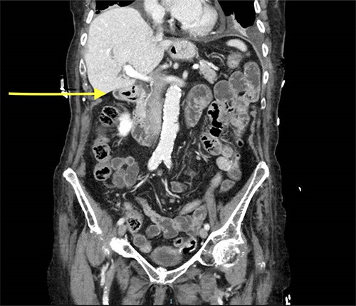 CT scan showing gastroduodenal intussusception (yellow arrow).