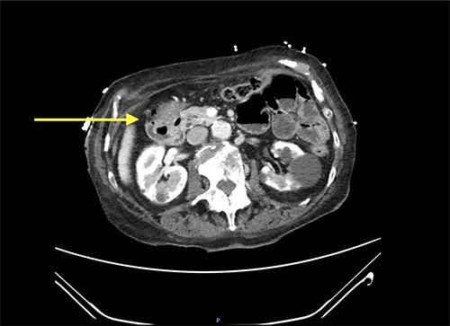 CT scan showing gastroduodenal intussusception (yellow arrow).