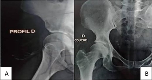 Standard X-ray of the hip profile (A) and face (B) with thickening of the soft tissue of the right hip with dispersed calcifications.
