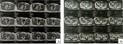 MRI showing a well-circumscribed mass in high signal intensity on Tl (A) and low signal intensity on T2 (B).