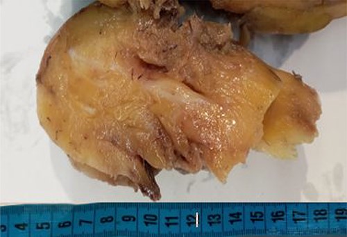 Cut section of the resected specimen showing the fatty appearance with ossified areas.