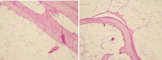 Microscopic image showing a fatty proliferation made of mature adipocytes dissociated by bony trabeculae (HE ×200, ×100).