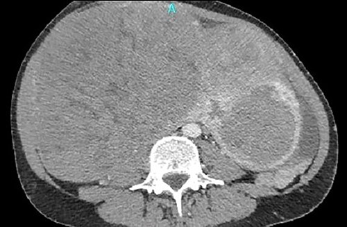 A huge mass originating from the uterine wall was revealed after pelvis CTA.