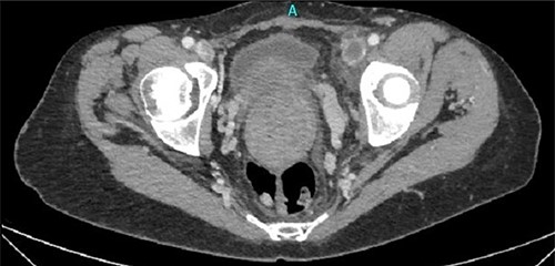 Thrombosis of left femoral and external and common iliac veins.