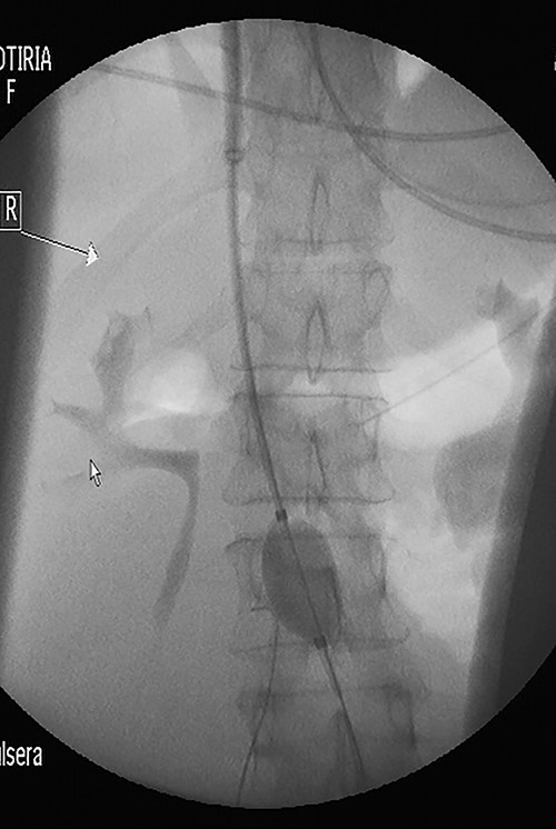 Under fluoroscopy, an aortic occlusion balloon catheter was positioned in the restricted free inferior caval space just below the renal veins.