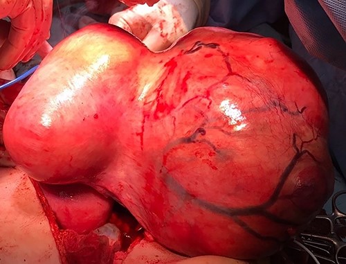 Resected uterine fibroids.