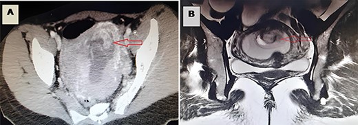 (A) A CT image revealing incarceration of a loop through a defect in the posterior wall of the uterus; (B) an MRI image revealing incarceration of a loop through a defect in the posterior wall of the uterus.