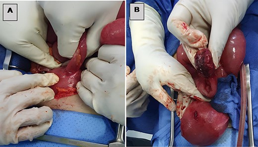 (A) Small bowel incarcerated at a uterine fundal perforation and (B) uterine perforation after loop extraction.