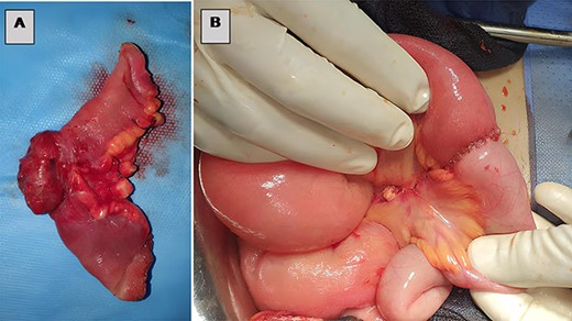 (A) Resected small bowel segment, (B) intestinal anastomosis.
