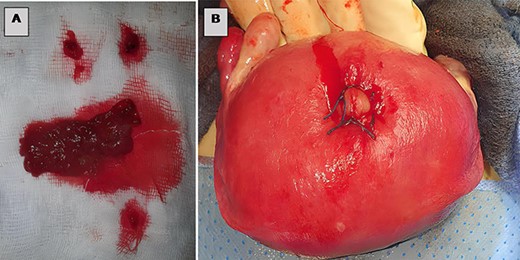 (A) Trophoblastic tissue, (B) closure of the uterine breach by X-stitches.
