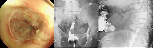 Endoscopic findings and gastrograffin enema 5 months after initial surgery.