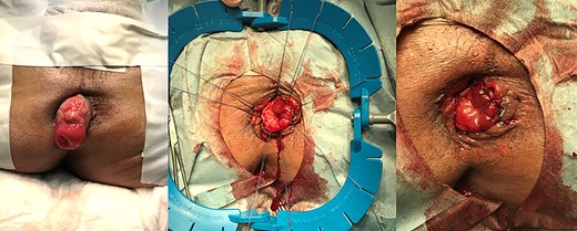 Trimming of the redundant colon and hand-sewn anastomosis.