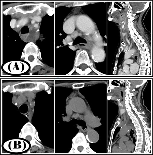 Case 1: pre- and post-treatment cervicothoracic CT; (A) pre-operative cervicothoracic CT and (B) cervicothoracic CT 4 weeks after treatment.