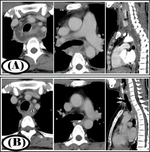 Case 2: pre- and post-treatment cervicothoracic CT; (A) pre-operative cervicothoracic CT and (B) cervicothoracic CT 5 weeks after treatment.