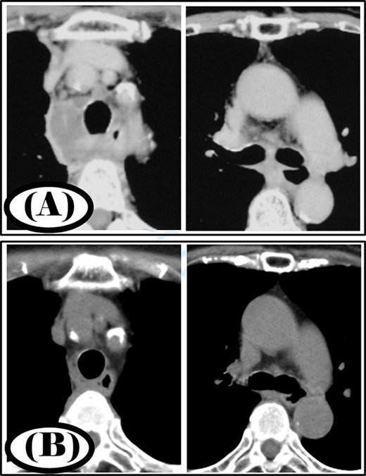 Case 3: pre- and post-treatment cervicothoracic CT; (A) pre-operative cervicothoracic CT and (B) cervicothoracic CT 4 weeks after treatment.