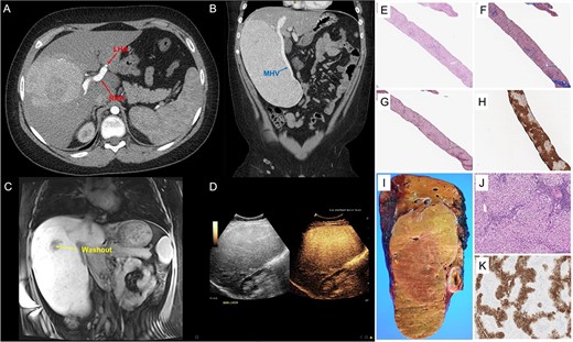 GFNH; (A–D) representative images from CT of the abdomen and pelvis with contrast, MRI of the liver with gadoxetate disodium and contrast-enhanced ultrasound; (A) the large, heterogenous mass in the right liver with an enlarged RHA and a diminutive LHA, and panel (B) further characterizes its exophytic nature, also demonstrating the enlarged MHV; panel (C) depicts a coronal section of an MRI of the liver with gadoxetate disodium showing the 14 cm × 11 cm × 21 cm, PRETEXT II lesion involving segments V, VI, VII and VIII and a small, central area of washout, and panel (D) shows homogenous hyperenhancement of the liver lesion on contrast-enhanced ultrasound; (E–K) pathological features of giant focal nodular hyperplasia; (E–H) needle core biopsy; proliferation of well-differentiated hepatocytes displaying a nodular architecture (E, Hematoxylin & Eosin, 40×) and separated by bands of fibrosis (F, trichrome stain, 40x and G, reticulin stain, 40×), and GS immunostain shows a geographic pattern (H, immunohistochemistry, 40×); (I and J) partial hepatectomy (segments 5, 6, 7 and 8) with cholecystectomy; coronal section of the right hepatectomy specimen demonstrating a tan-yellow and well-circumscribed mass measuring 22.1 × 13.0 × 6.0 cm (I, gross picture) with hepatocellular proliferation with nodular architecture and containing occasional abnormal vessels and ductules (J, Hematoxylin and Eosine, 100×); GS performed in the resection specimen also displays a geographic pattern of staining (K, immunohistochemistry, 40×).