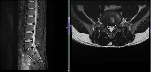 Case 1 L5-S1 level: there is disc desiccation and slight disc height loss; there is disc protrusion (including a cystic component) with impingement to the left traversing S1 nerve root.