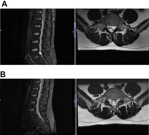 (A) Case 2—initial MRI shows a slightly unusual abnormality associated with the L5-S1 compressing the left transiting S1 nerve root and is almost certainly a fragment of extruded/sequestered disc, and (B) case 2—updated MRI shows a significant decrease in the previously seen cystic lesion at L5-S1 level now measuring 4 mm (AP diameter, previously 11 mm).
