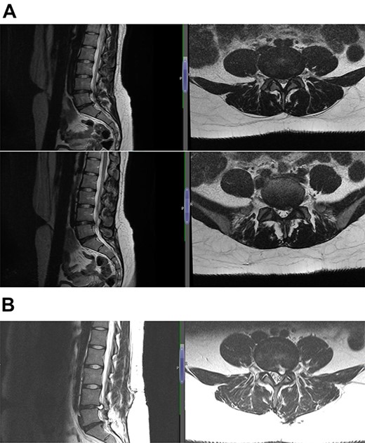 (A) Case 3—an early MRI demonstrates at L5/S1 level moderate diffuse disc bulge is seen with early bilateral facet joint degenerative changes; there is irritation of the L5 nerve roots bilaterally, and at L5/S1 level moderate left posterolateral disc bulge is seen irritating the S1 nerve roots bilaterally left more than right, and bilateral facet joint degenerative changes also noted at this level, and (B) case 3—a later MRI, the cystic changes noted at the L4-L5 level which clearly shows a connection with the intervertebral disc.