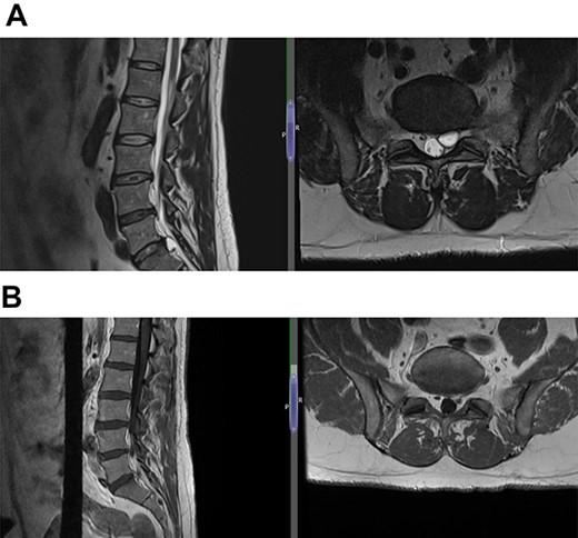 (A) Case 4—an initial MRI showing multilevel degenerative disc disease and a cyst at the lumbar L5/S1 which is causing impingement on the left S1 nerve root, and (B) case 4—comparison was made with the previous MRI; post-contrast scan shows that the L5-S1 left-sided cystic features have nearly diminished; no neoplastic lesion is detectable.
