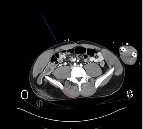 Axial view of the CT demonstrates the tear in the rectus muscle (blue arrow). Inferior lumbar hernia can be clearly demonstrated, above the iliac crest (red arrow).